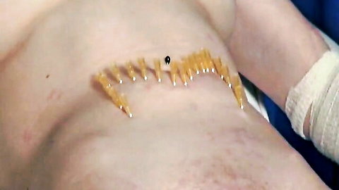 Man's bare abdomen pierced with dozens of yellow needles in extreme BDSM torture play